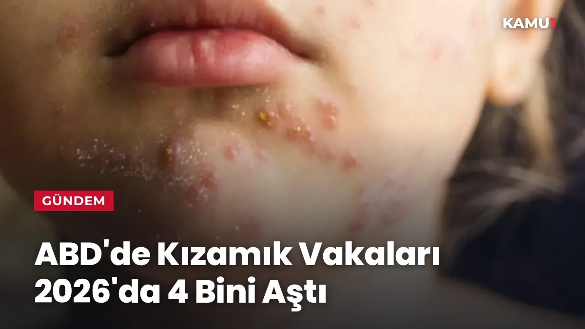 ABD'de 2026 yılında artan kızamık vakalarını gösteren sağlık temalı illüstrasyon